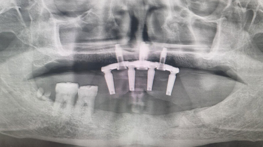 Fig. 10 - RX dopo 3 Mesi. Si è proceduto con l’inserimento dei monconi più provvisorio fisso.