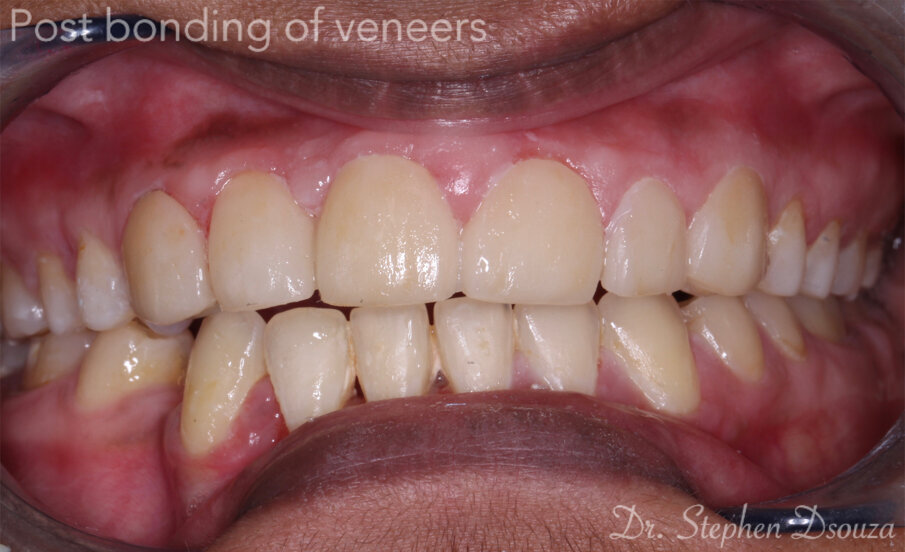 Fig 15: Post bonding of veneers