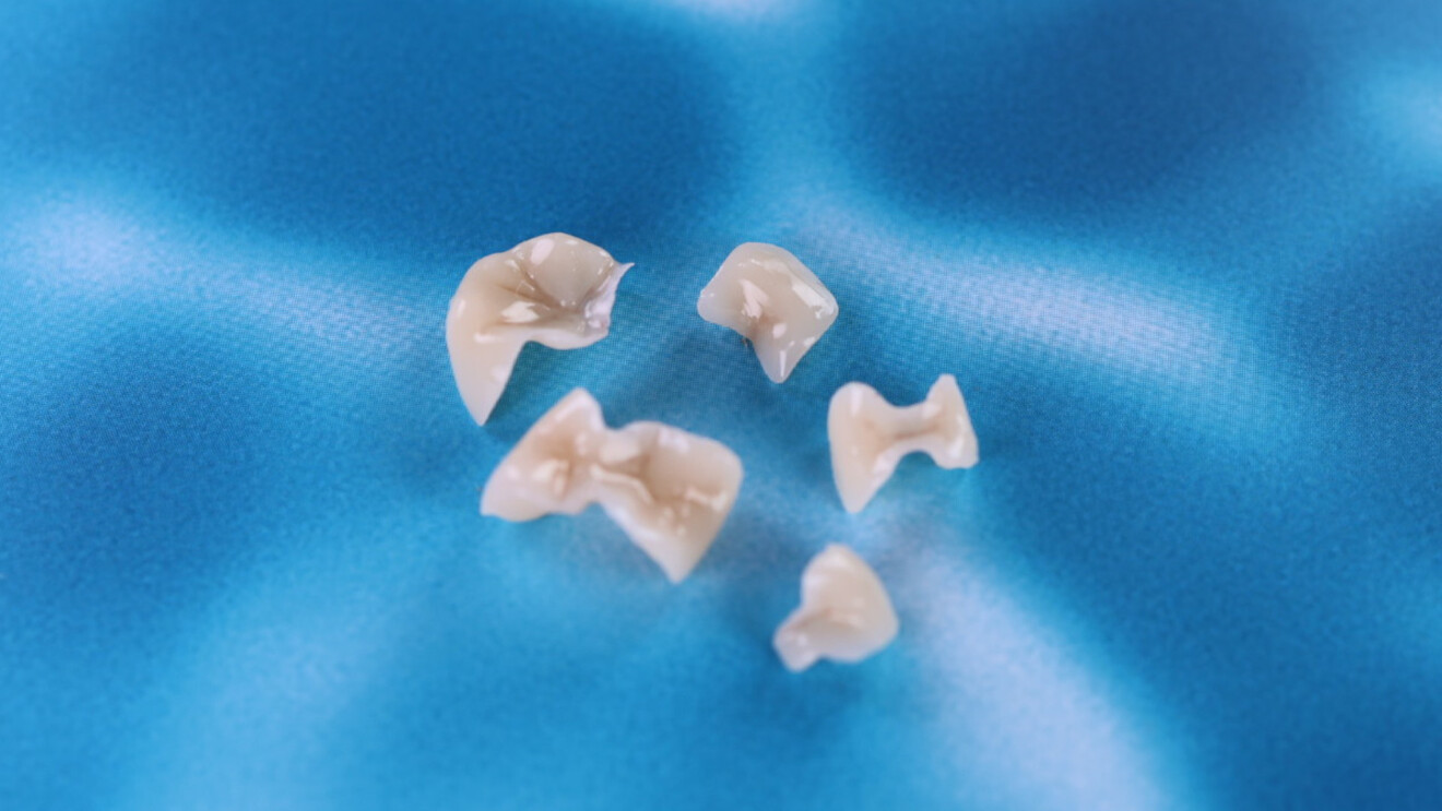 Fig. 6: 3D-printed restorations before cementation.