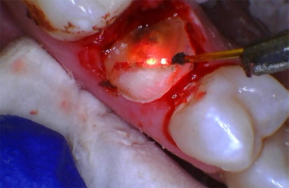 Fig. 15: Laser treatment of the pulpal exposure after caries removal.