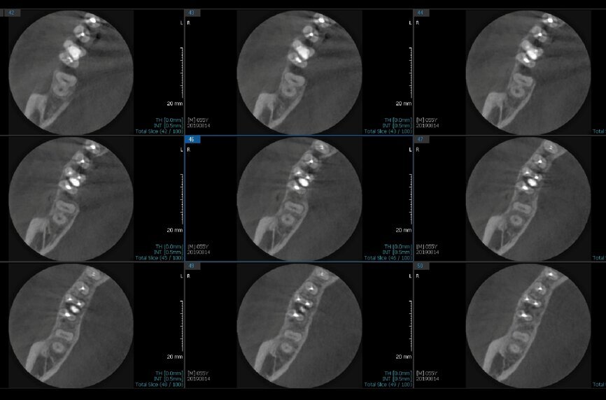 Fig. 6e: Post-op CBCT images of tooth #46 showing adequately obturated canals at all levels to the working length and sealing of the furcation defect.