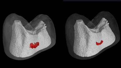 New device to treat caries with electric remineralisation