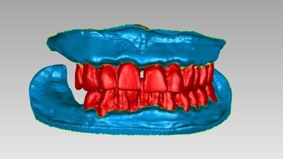 Precisie, efficiëntie en voorspelbaarheid met de Digitale AvaDent-immediaatprothese