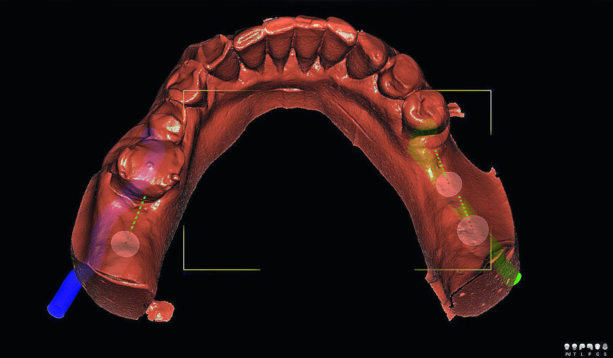 Fig. 1a: Virtual planning of implant positioning.
