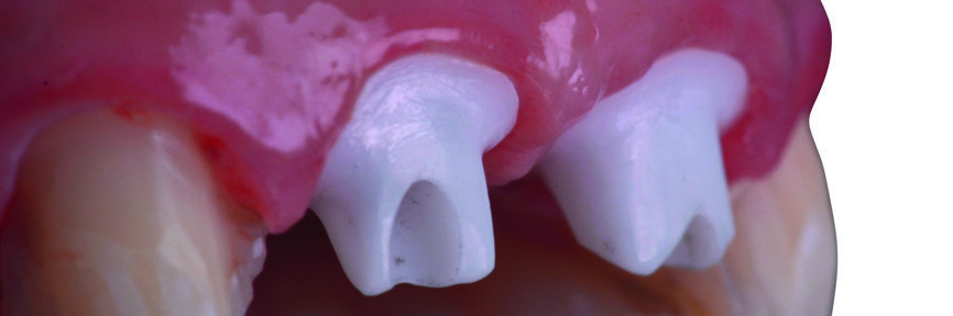 Fig. 32 : Les piliers personnalisés en Zr après leur parfaite insertion.