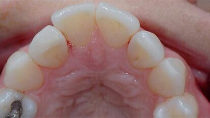 Non-invasive mini porcelain veneers: An alternative to direct resin restorations