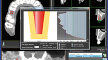 EGIS, novedades en cirugía implantoprotésica guiada