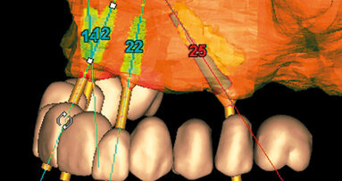 Impianti trans-sinusali per la riabilitazione del mascellare atrofico: serie di 32 casi in pazienti totalmente edentuli