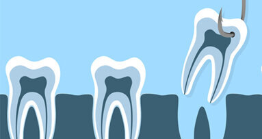 Extraktion dritter Molaren – Welche Probleme treten danach auf?