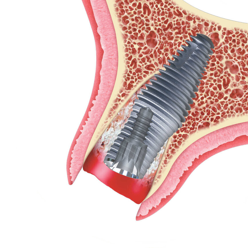 Inverta implant