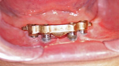 Role kovových nano a mikročástic v periimplantitidě