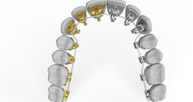 O lingvální ortodoncii