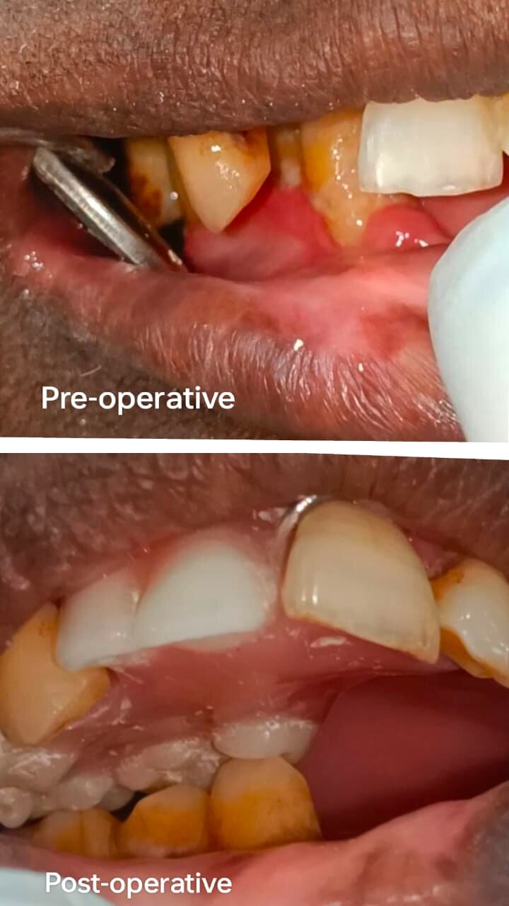 Twin occlusion case 2