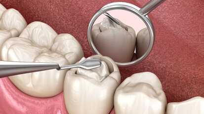 Einigung zwischen ÖZÄK und KFA Wien über Amalgamersatz und Pilotprojekt zur Mundhygiene