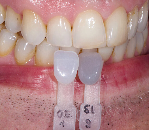 Fig. 3: Determining the light-optical characteristics with a special shade sample (in this case Opal Effect materials)
