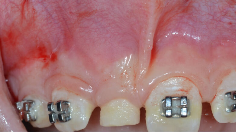 Diagnosi e trattamento multidisciplinare di un odontoma composto.  Descrizione di un caso clinico