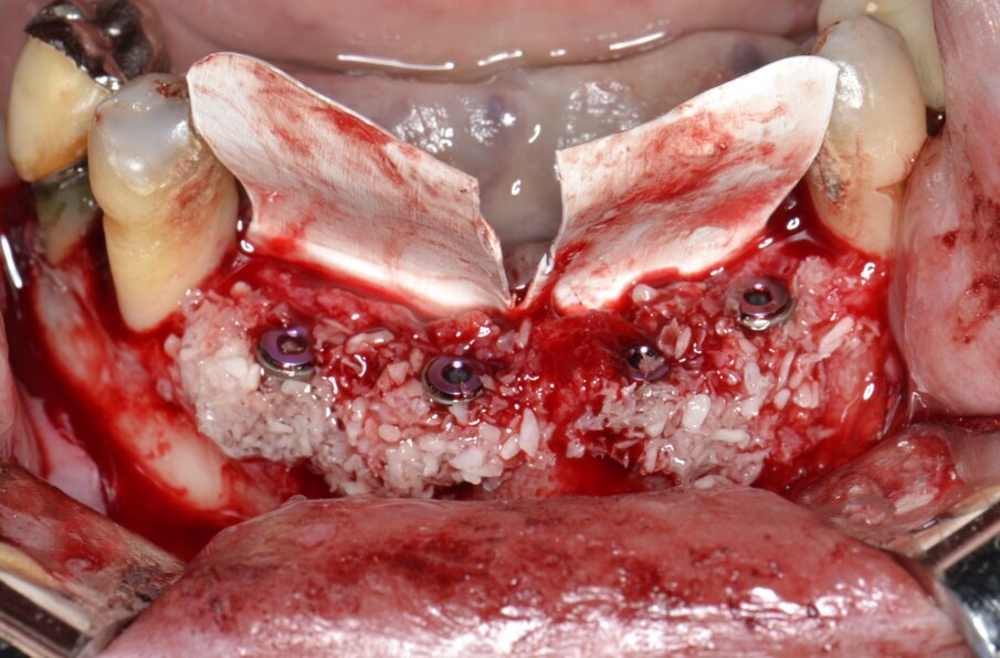 Fig. 9 - Un innesto composto da osso autologo in chips e biomateriale di origine eterologa viene posizionato intorno agli impianti.