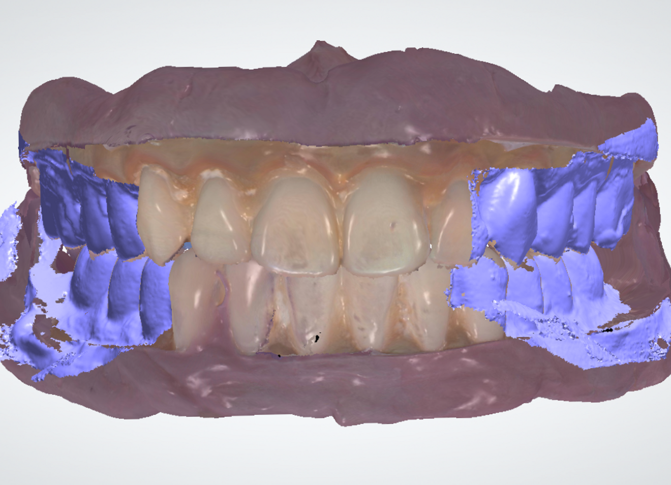 Fig. 15: Matching the maxillary and mandibular scans with the occlusal registration scan.