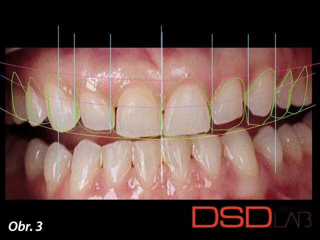 Obr. 3: Digital smile design indikuje prodloužení korunek zubů 13, 12, 11 a 21 a rekonstrukci deseti předních zubů.