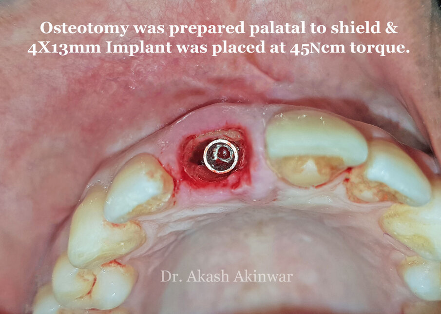 Fig 16: Implant placed at 45 Ncm