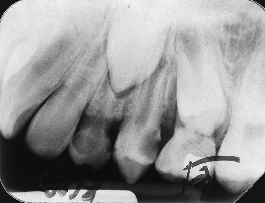 Case 2: Male (born 28 December 1980): Tooth 14
Fig. 4a: 18 August 1989 ante vitalextirpation.