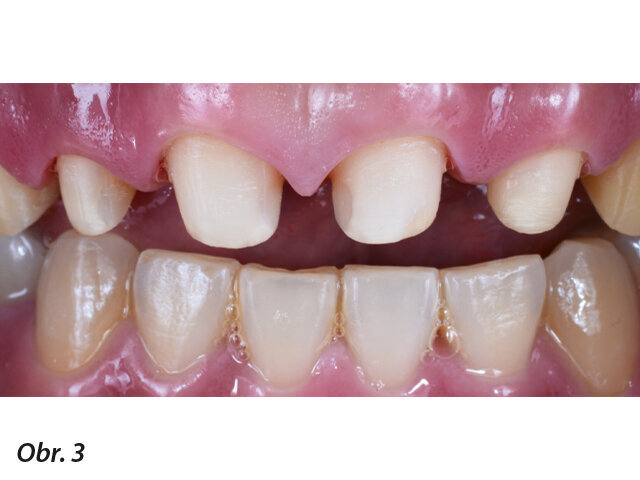Obr. 3: Situace po odstranění kariézních lézí a ošetření kořenového kanálku
