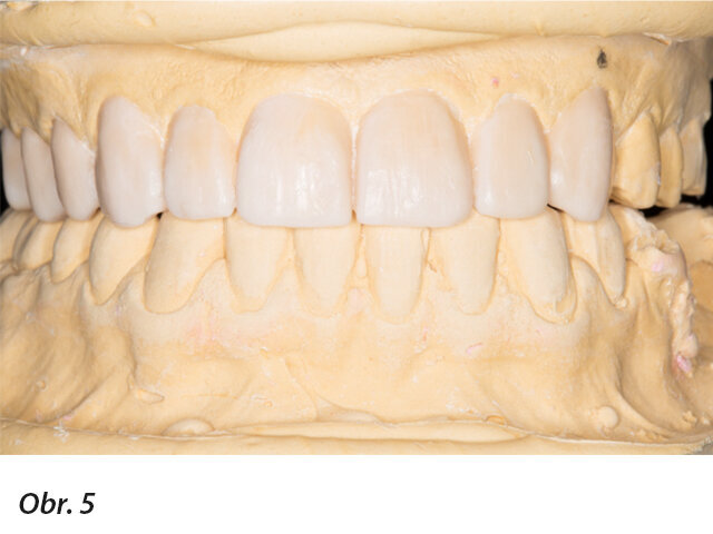 Funkční analýza wax-upu