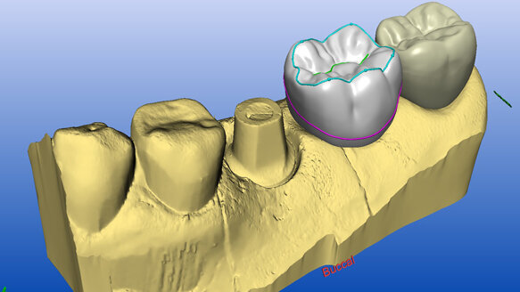 Safety-first implant therapy