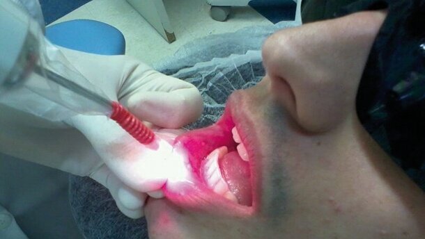 Laser vs traitements classiques