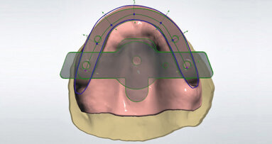 Digitální celkové náhrady