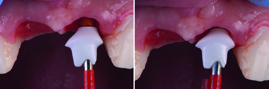 Fig. 31 : Le pilier personnalisé en Zr est vissé sur l’implant. 