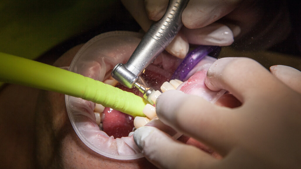 Stanowisko FDI wobec leczenia zachowawczego i próchnicy głębokiej