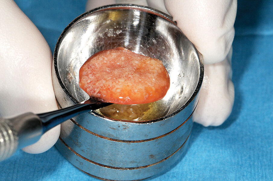 Fig. 15: After 10 to 12 minutes, the fibrin within the plasma that had been mixed with the allograft particles forms a gelatinous mass referred to as ‘gummy bone.’