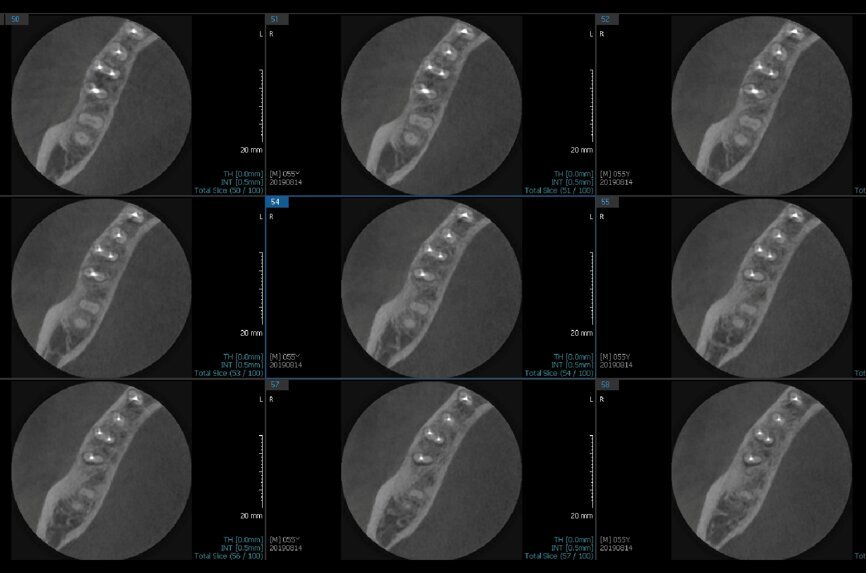 Fig. 6d: Post-op CBCT images of tooth #46 showing adequately obturated canals at all levels to the working length and sealing of the furcation defect.