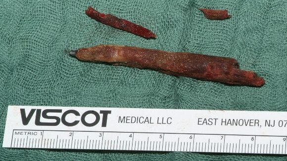 Homem vive com lápis no seio maxilar por anos