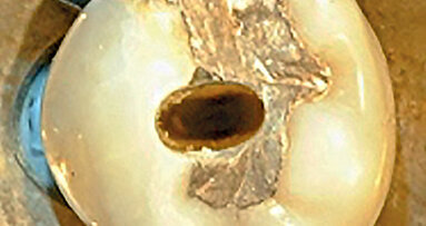 Příprava vstupů do kořenových kanálků – předpoklad úspěšné endodoncie