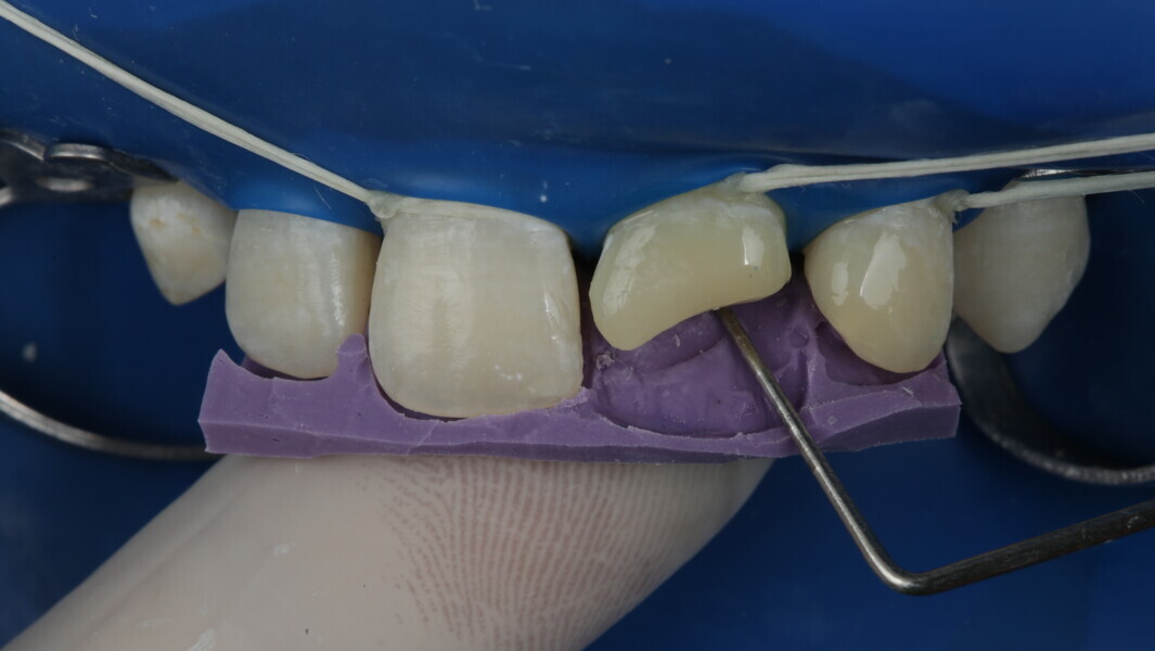 Fig 15: The extent of the palatal surface was marked using a probe.