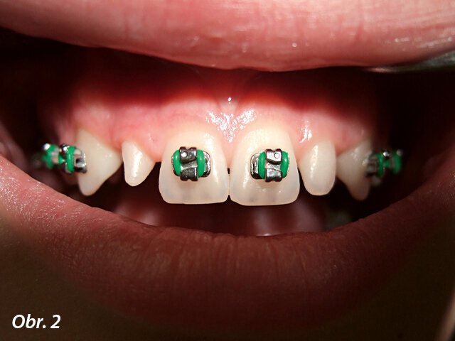 Drobné laterální řezáky u 1. případu.