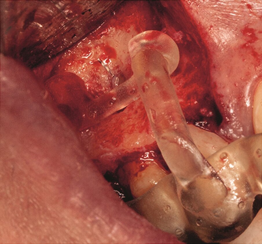 Fig. 2h: The template was adjusted and the limits of the cortical window were marked in the bone.