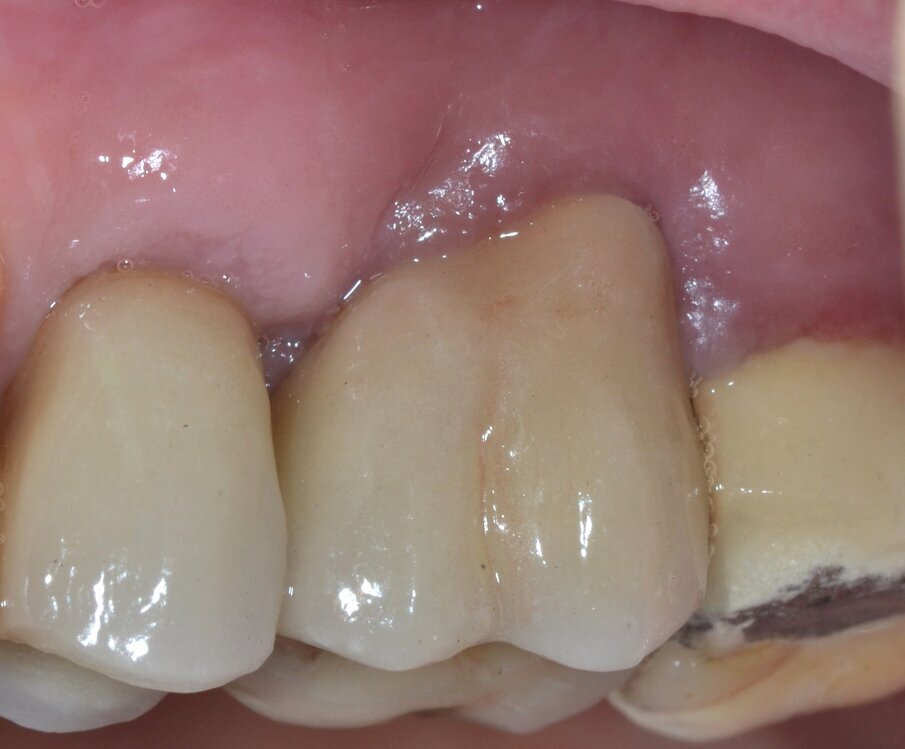 Fig. 11 - Immagine clinica postoperatoria (follow-up a 5 anni).