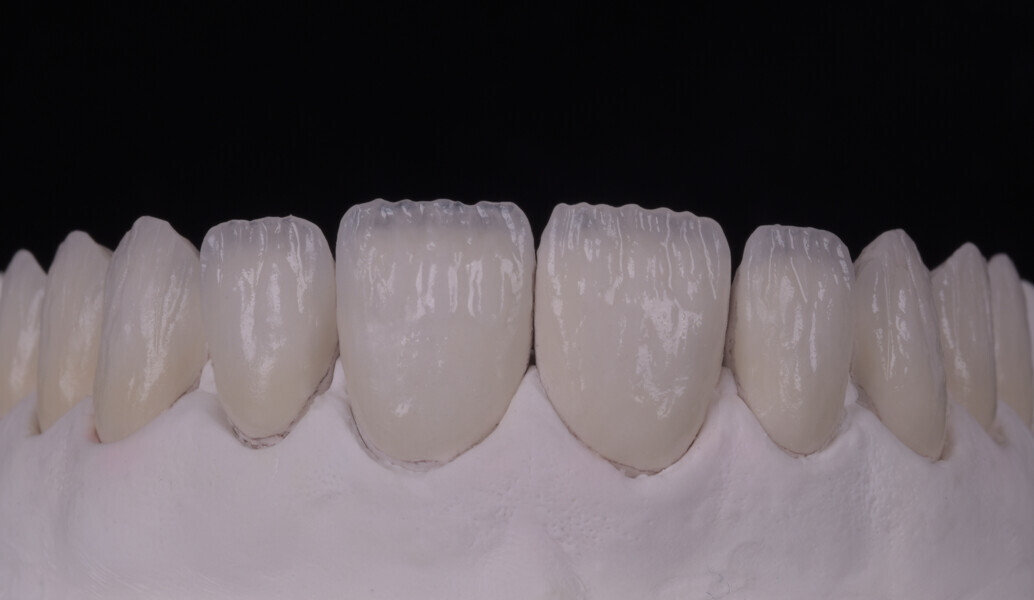 Fig. 11a: First ceramic layering ...