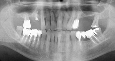 Apport des technologies numériques et de la CFAO en prothèse implantaire vissée : deux cas cliniques