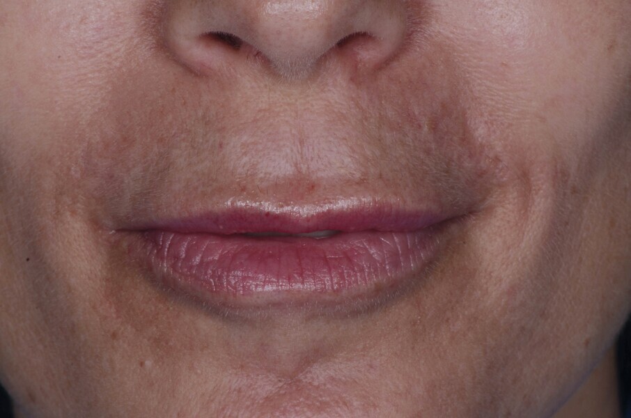 Fig. 1a : Vue préopératoire extraorale : lèvres au repos a 
