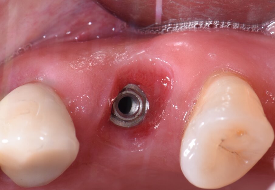 Fig. 3 - Si può notare il trofismo e il volume dei tessuti periimplantari 3 mesi dopo l’inserimento dell’impianto.
