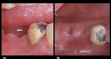 Restauración protésica sobre implantes desconocidos