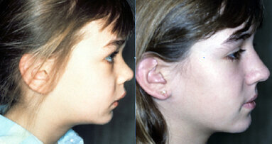 Results for Nite-Guide preventive and interceptive procedure