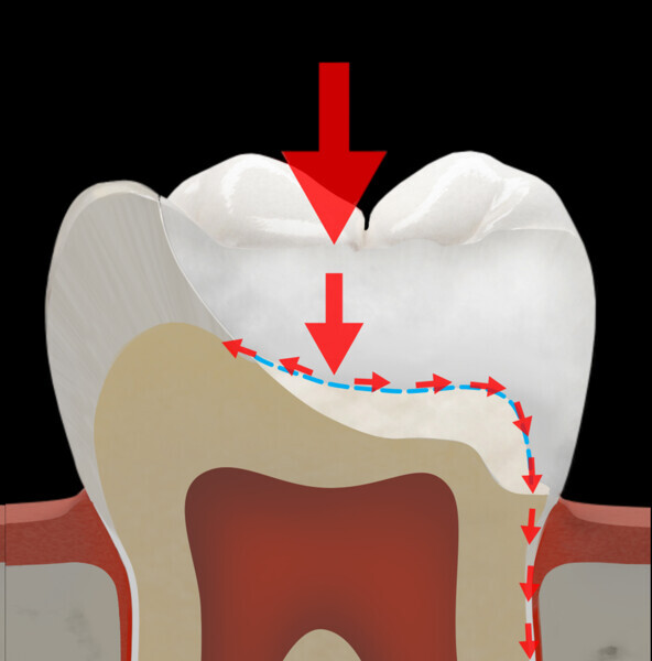 Fig. 39c: Schematic representation of the stress distribution in a typical tooth crown (a) and in a crown restoration of a molar without a fibre-reinforced membrane (b) and with a fibre-reinforced membrane (c).