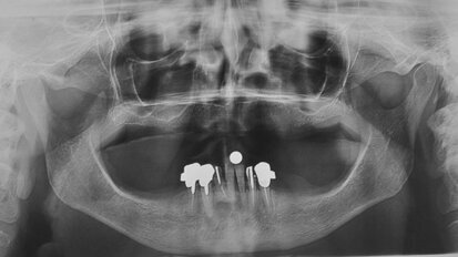 Impianti short a carico immediato in grave atrofia mandibolare