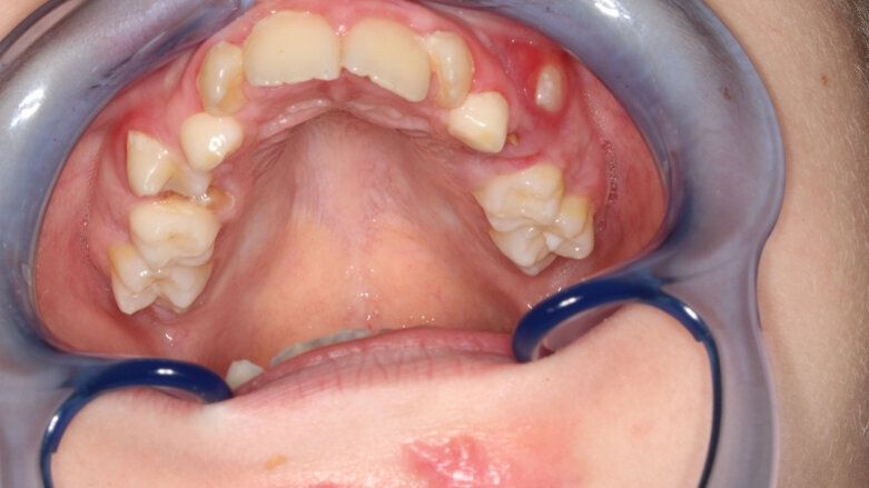 “Praatjes vullen geen gaatjes, maar voorkomen gaatjes”
