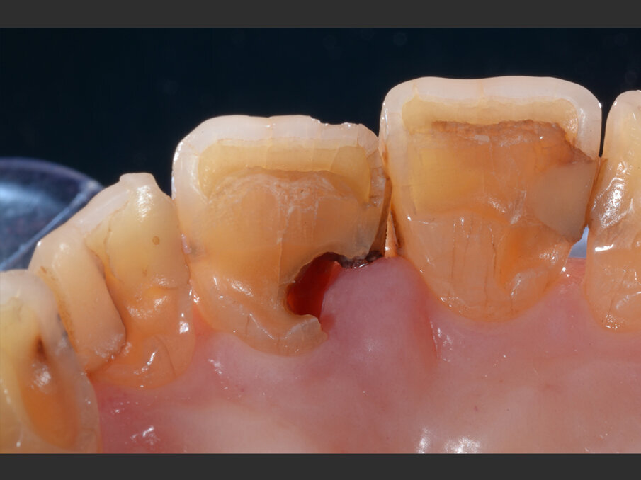 Fig. 1b - Valutazione pre-operatoria - visione palatina: è possibile apprezzare la lesione cariosa corono-radicolare.